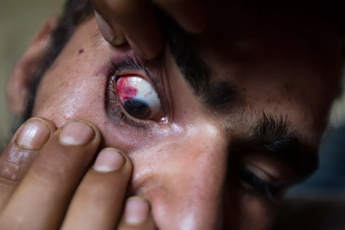 Pellet Injuries/ Please Do Not Use